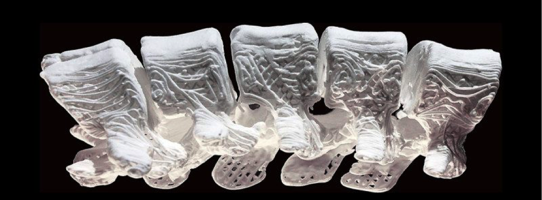 3D rendering of a bone implant